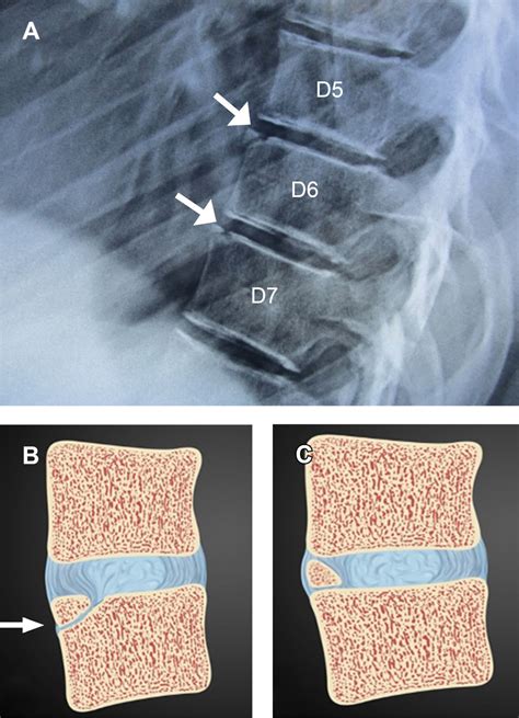 limbus vertebrae treatment.